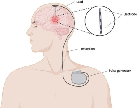 Best DBS Surgery Cost, Success Rate, Recovery & Risk