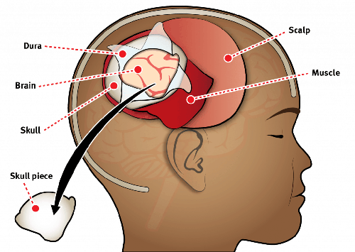 Best Craniotomy Surgery Cost, Success Rate, Recovery & Risk