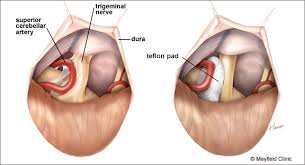 Microvascular Decompression success,Risk,Treatment