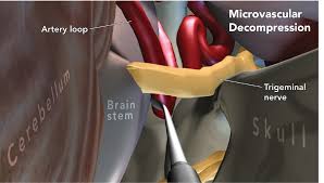 Microvascular Decompression success,Risk,Treatment