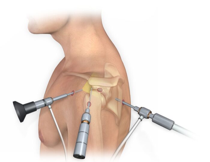Experience a Swift Recovery with Arthroscopic Surgery in India