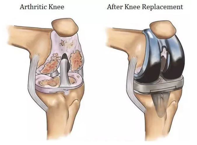 Expert Knee Surgery in India with the best cost