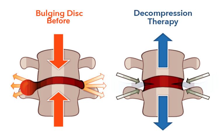 High-Quality, Best Spinal Decompression Surgery In India[2025]