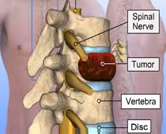 High-Quality, Best Spinal tumor Surgery In India