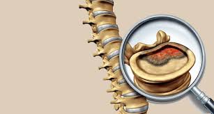 High-Quality, Best Spinal tumor Surgery In India